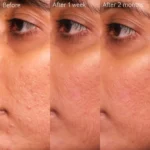 سرم سالیسیلیک اسید ضدجوش و کنترل آکنه وینوپیور کدلی - Image 3